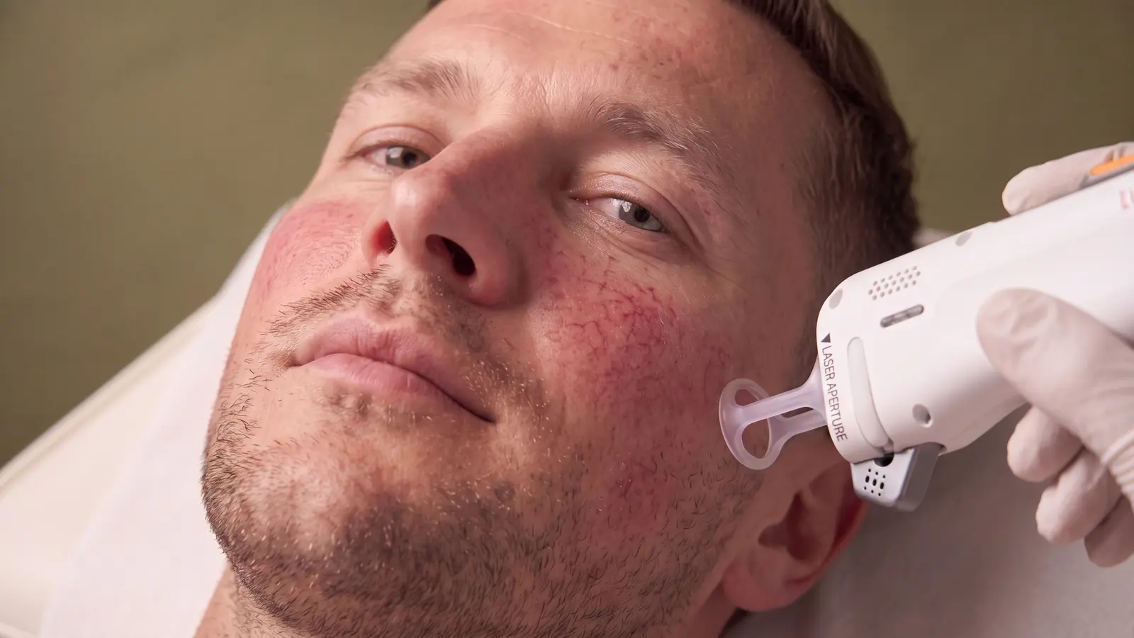 Удаление сосудов на лазере DermaV