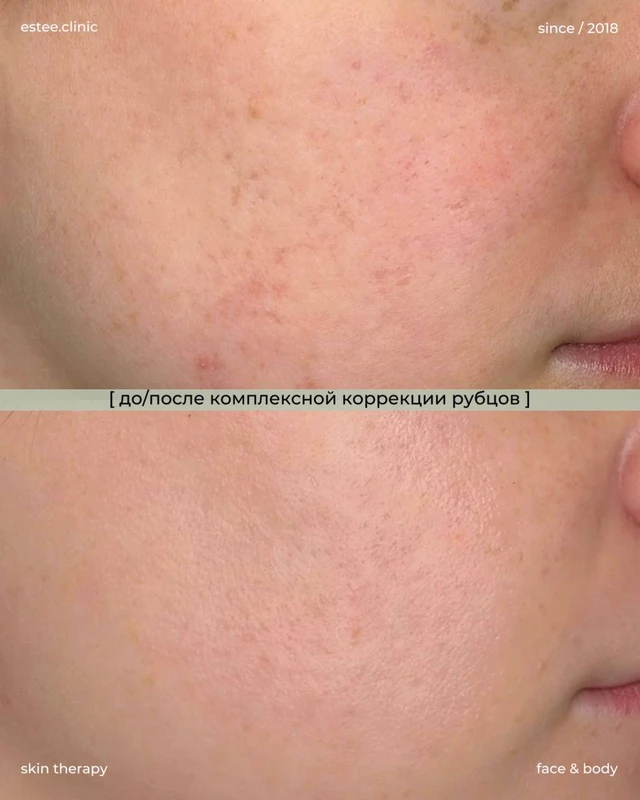 Коррекция рубцов постакне