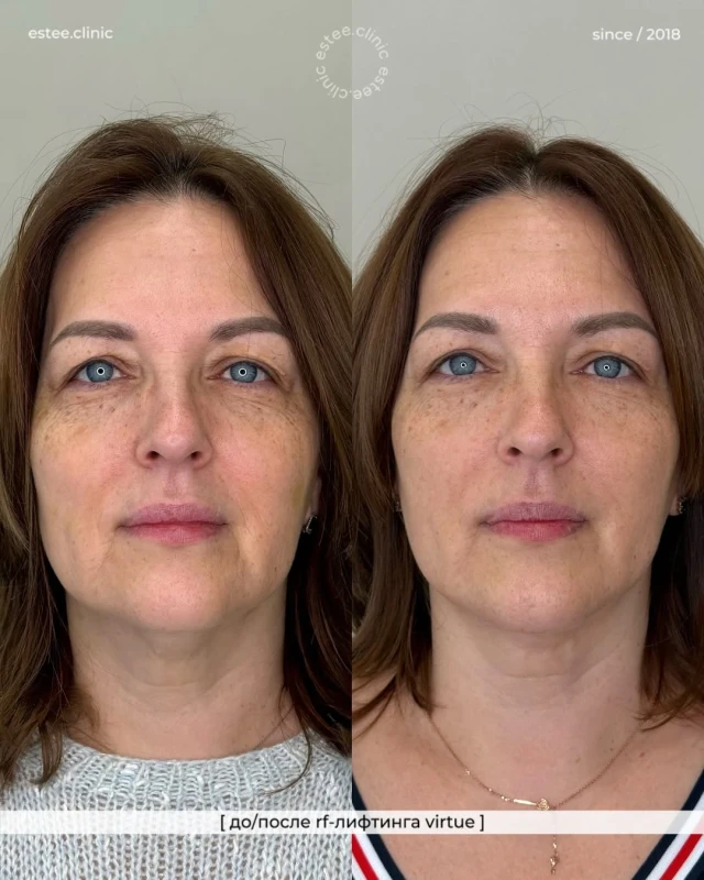 Микроигольчатый RF-лифтинг Virtue