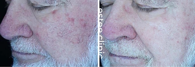 Лечение сосудов на лице аппаратом Derma V (5 процедур)