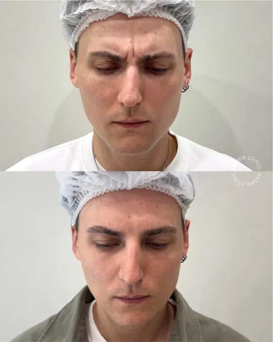 Ботулинотерапия