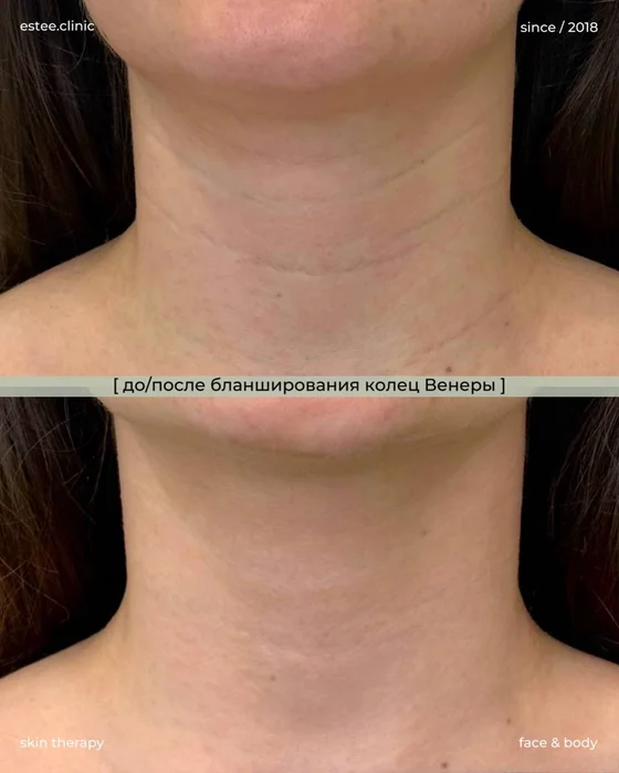 Бланширование колец Венеры