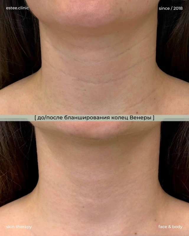 Бланширование колец Венеры