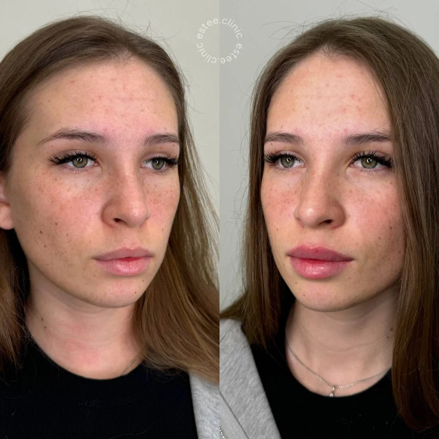 Контурная пластика губ