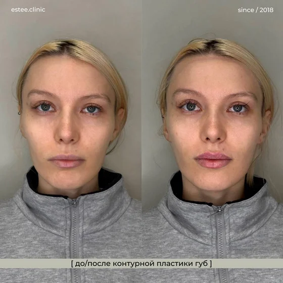 Контурная пластика губ