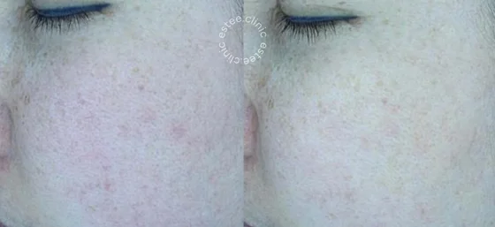 Лечение розацеа аппаратом Derma V