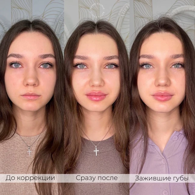 Контурная пластика губ