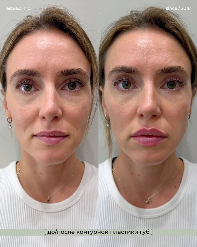 Коррекция асимметрии губ