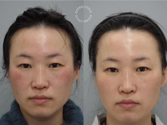 Лечение розацеа аппаратом Derma V