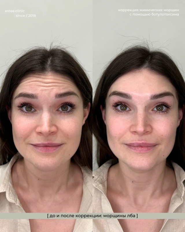 Ботулинотерапия