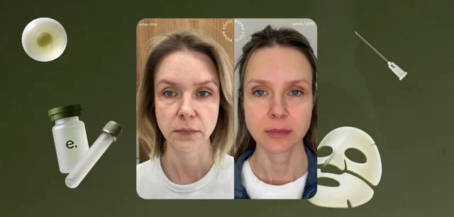 Кейс estee clinic: комплексный протокол улучшения качества кожи