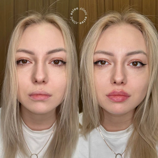 Контурная пластика губ