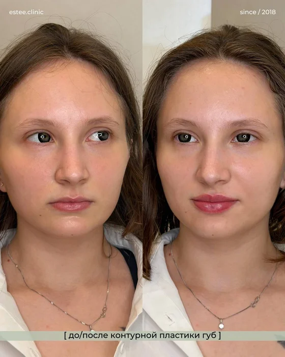 Контурная пластика губ