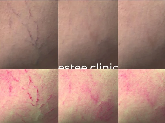 Лечение сосудов на нижних конечностях аппаратом Derma V