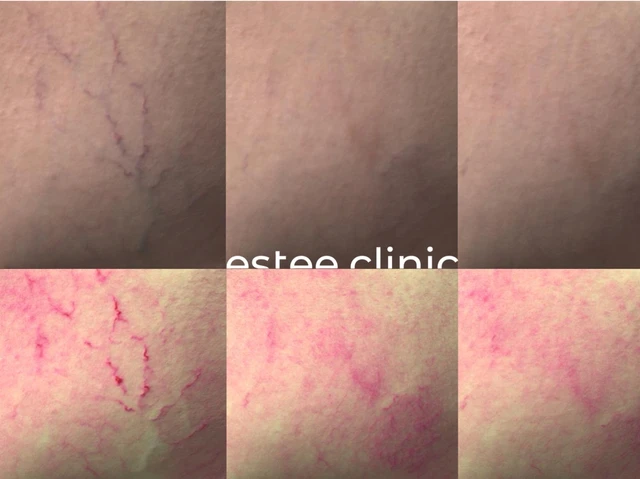 Лечение сосудов на нижних конечностях аппаратом Derma V