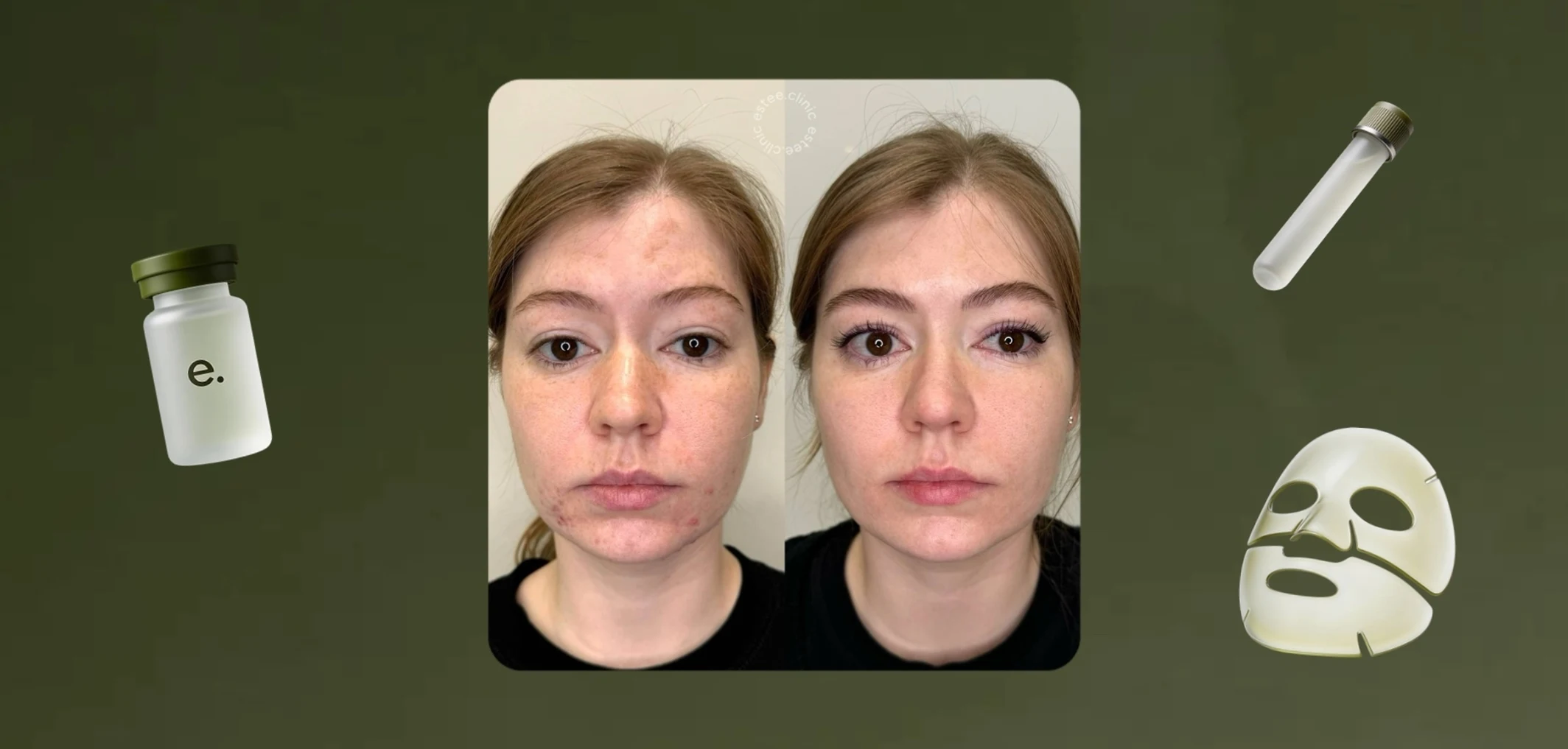 Кейс estee clinic: лечение акне
