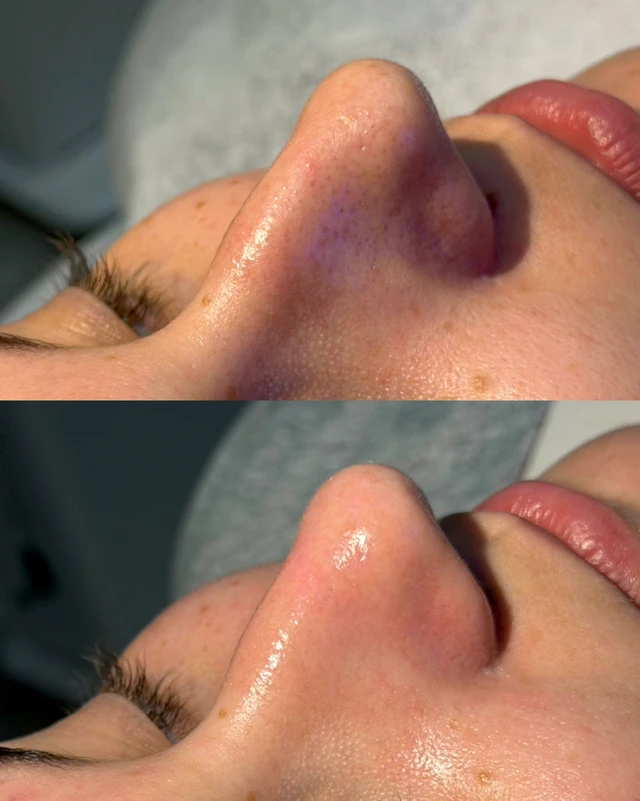 Чистка лица HydraFacial