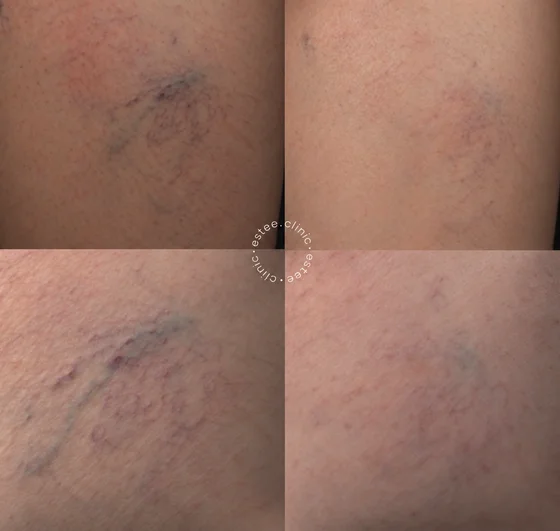 Лечение сосудов на ногах аппаратом Derma V ( 3 процедуры )
