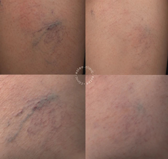 Лечение сосудов на ногах аппаратом Derma V ( 3 процедуры )